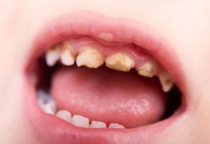 baby-bottle-tooth-decay-300x206.jpg